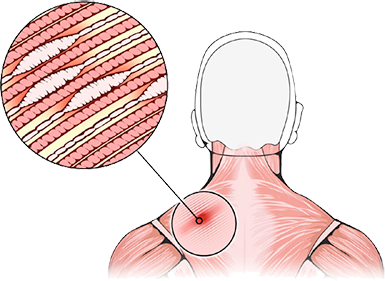 An illustration close up of a trigger point location