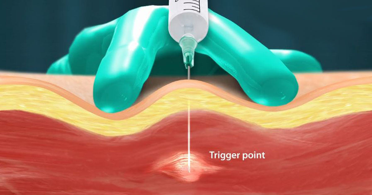 Illustration of an injection into a trigger point