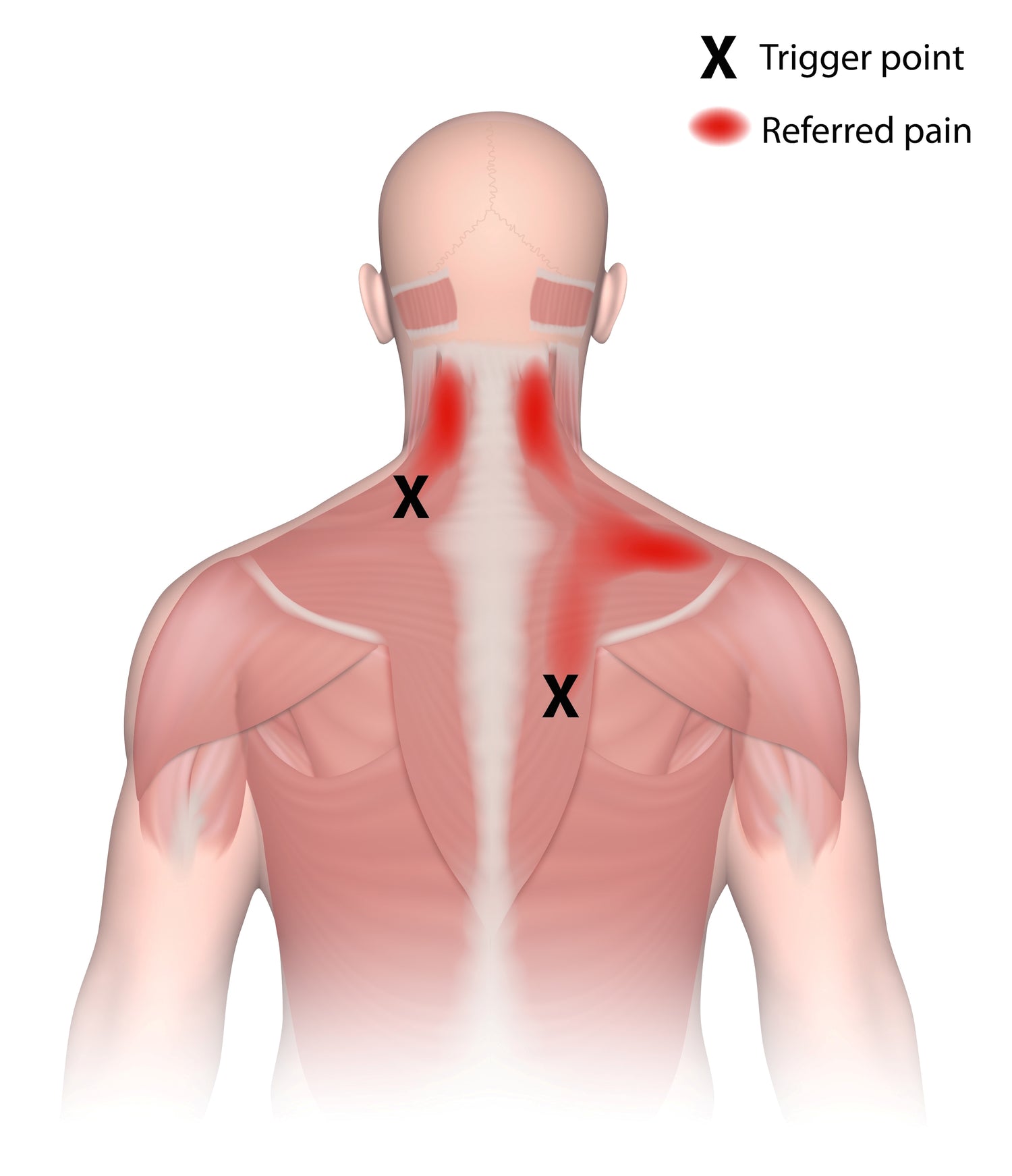 Diagram showing where trigger points may be and the location of the referred pain associated with the trigger point